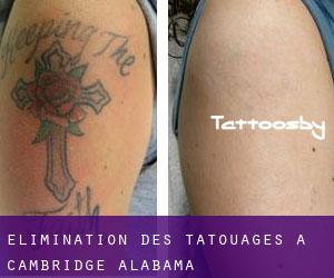 Élimination des tatouages à Cambridge (Alabama)
