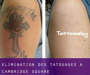 Élimination des tatouages à Cambridge Square
