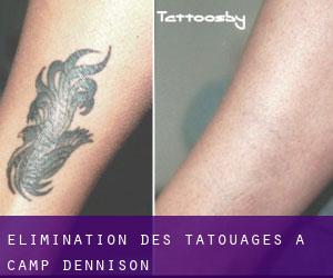 Élimination des tatouages à Camp Dennison