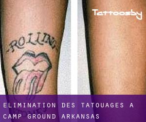Élimination des tatouages à Camp Ground (Arkansas)