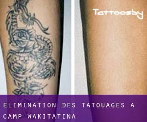 Élimination des tatouages à Camp Wakitatina
