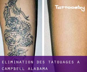 Élimination des tatouages à Campbell (Alabama)