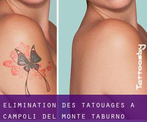 Élimination des tatouages à Campoli del Monte Taburno