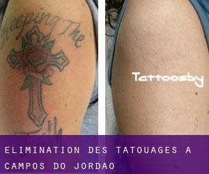 Élimination des tatouages à Campos do Jordão