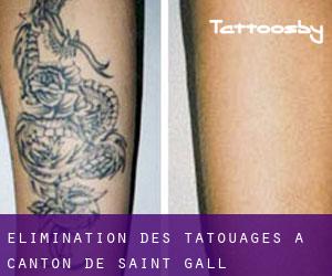 Élimination des tatouages à Canton de Saint-Gall