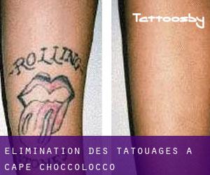 Élimination des tatouages à Cape Choccolocco