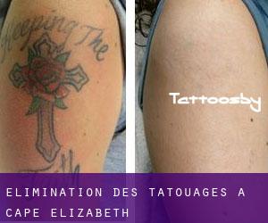 Élimination des tatouages à Cape Elizabeth