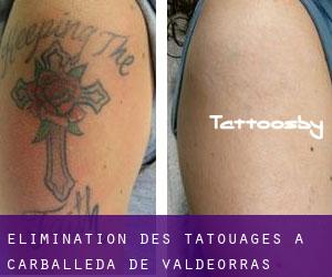 Élimination des tatouages à Carballeda de Valdeorras