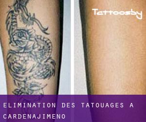 Élimination des tatouages à Cardeñajimeno