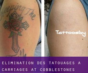 Élimination des tatouages à Carriages at Cobblestones
