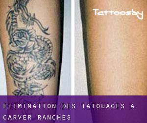 Élimination des tatouages à Carver Ranches