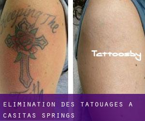 Élimination des tatouages à Casitas Springs