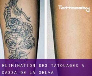Élimination des tatouages à Cassà de la Selva