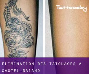 Élimination des tatouages à Castel d'Aiano