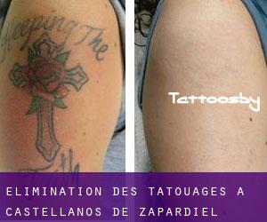 Élimination des tatouages à Castellanos de Zapardiel