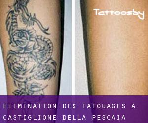 Élimination des tatouages à Castiglione della Pescaia