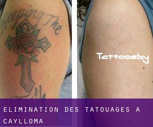 Élimination des tatouages à Caylloma