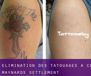Élimination des tatouages à CC Maynards Settlement