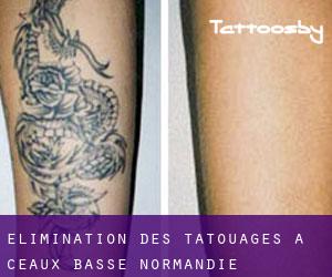 Élimination des tatouages à Céaux (Basse-Normandie)