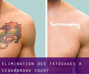 Élimination des tatouages à Cedarbrook Court
