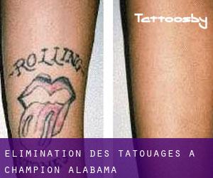 Élimination des tatouages à Champion (Alabama)