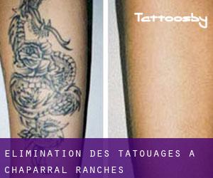 Élimination des tatouages à Chaparral Ranches