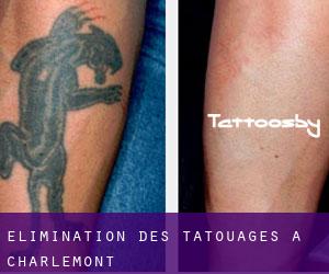 Élimination des tatouages à Charlemont
