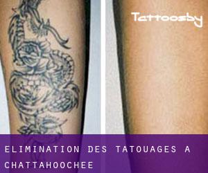 Élimination des tatouages à Chattahoochee