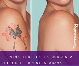 Élimination des tatouages à Cherokee Forest (Alabama)