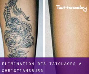 Élimination des tatouages à Christiansburg