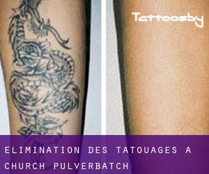 Élimination des tatouages à Church Pulverbatch