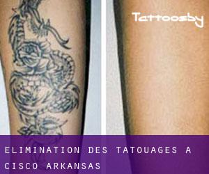 Élimination des tatouages à Cisco (Arkansas)