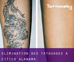 Élimination des tatouages à Citico (Alabama)