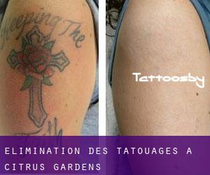 Élimination des tatouages à Citrus Gardens