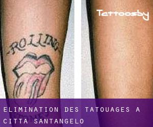 Élimination des tatouages à Città Sant'Angelo