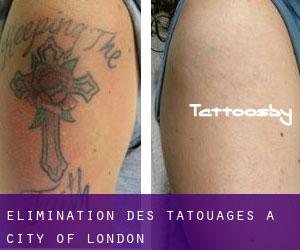 Élimination des tatouages à City of London