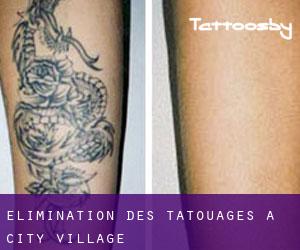 Élimination des tatouages à City Village