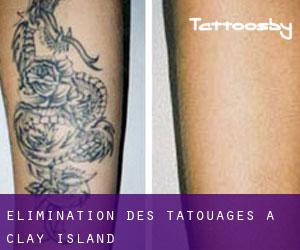 Élimination des tatouages à Clay Island