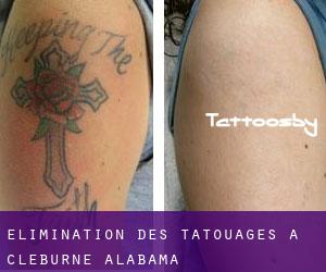 Élimination des tatouages à Cleburne (Alabama)