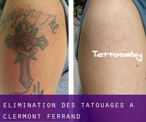 Élimination des tatouages à Clermont-Ferrand