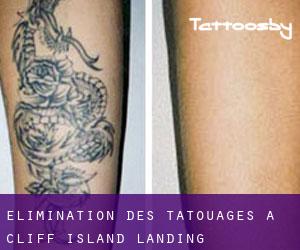 Élimination des tatouages à Cliff Island Landing