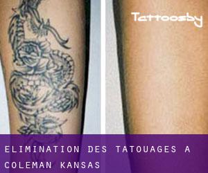 Élimination des tatouages à Coleman (Kansas)