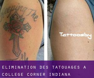Élimination des tatouages à College Corner (Indiana)
