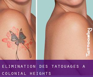 Élimination des tatouages à Colonial Heights