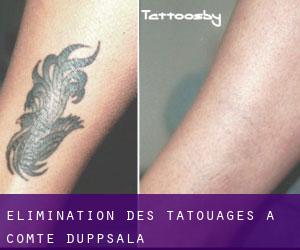 Élimination des tatouages à Comté d'Uppsala