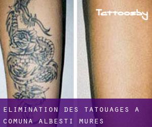 Élimination des tatouages à Comuna Albeşti (Mureş)
