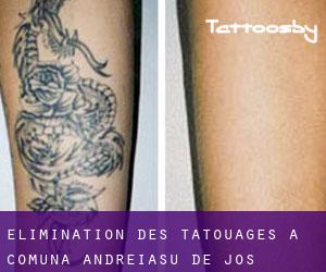 Élimination des tatouages à Comuna Andreiaşu de Jos
