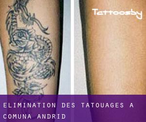Élimination des tatouages à Comuna Andrid