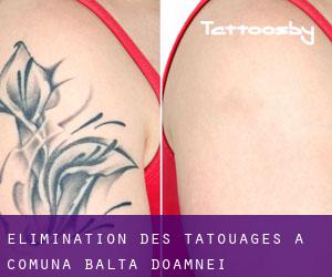 Élimination des tatouages à Comuna Balta Doamnei