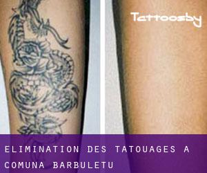 Élimination des tatouages à Comuna Bărbuleţu